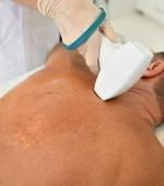 Laser Progressively Definitive Hair Removal – Back (Men)